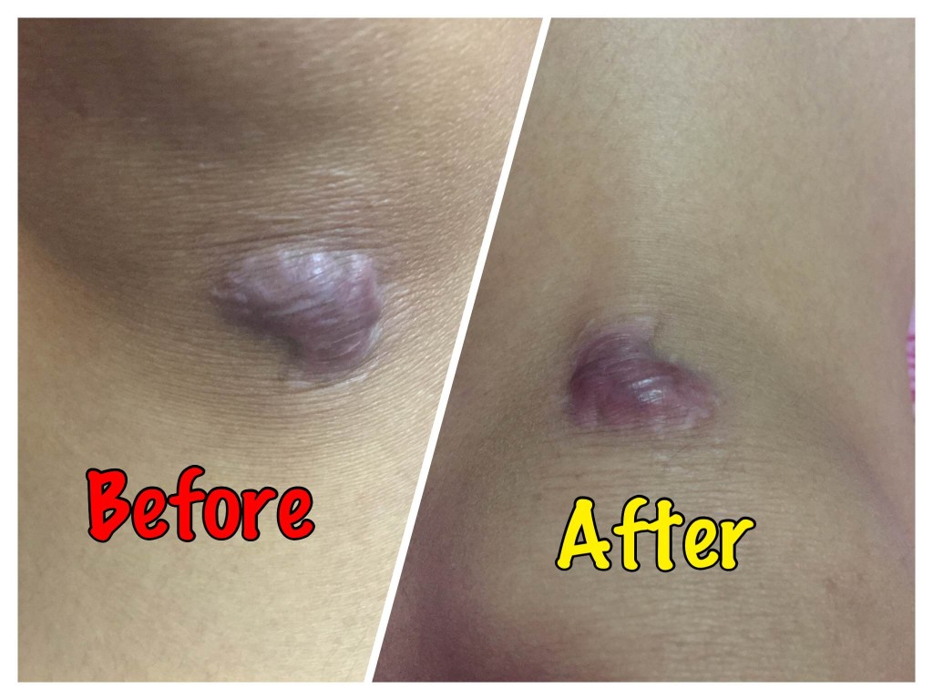 Keloid Scarring Before and After Intralesional Steroid Injection